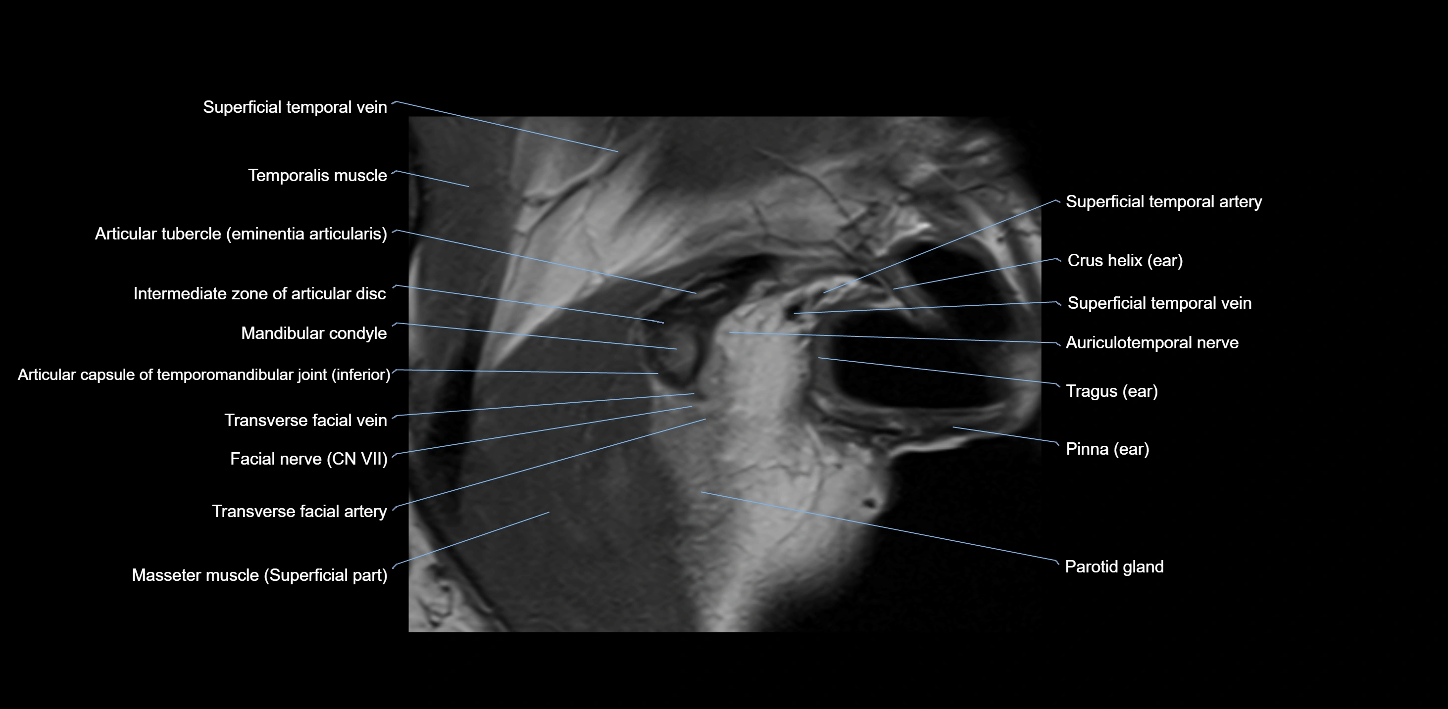 MRI TMJ sagittal open  mouth cross sectional 3T anatomy -img-00001-00003.webp